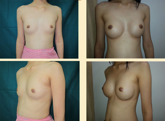 Breast Augmentation Surgeon Mumbai