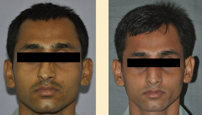 Before and after photos of Rhinoplasty