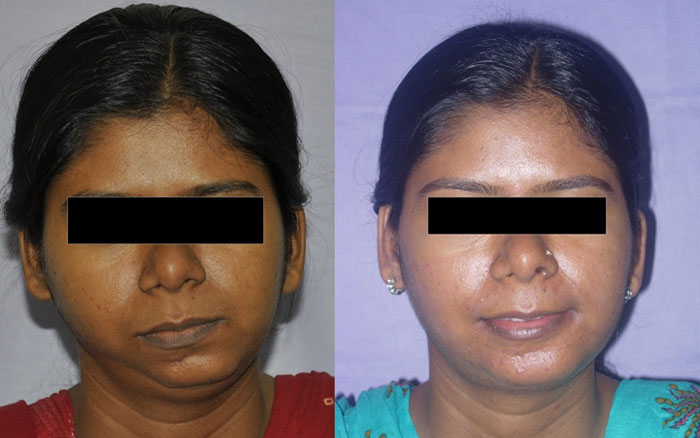 Chin Reduction Surgery Mumbai, Maharashtra 