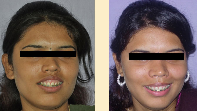 Gummy Smile correction done in Mumbai