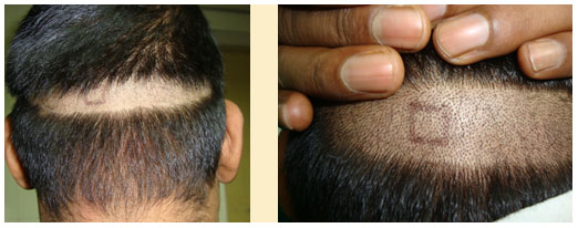 Hair Transplant Surgery in Mumbai