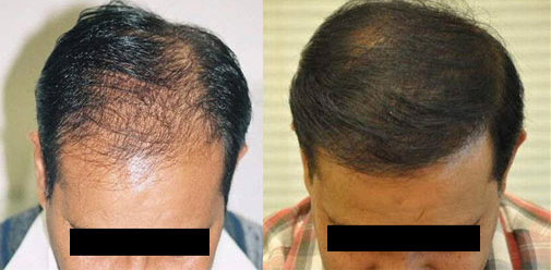 Before & After Photos for Hair Transplant