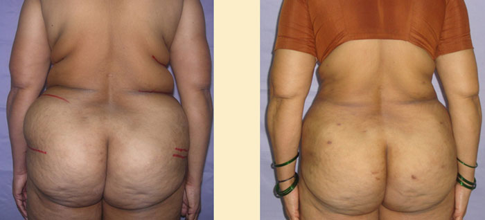 Liposuction procedure done in Agra