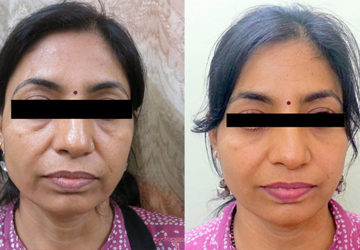 Eye bag surgery Mumbai