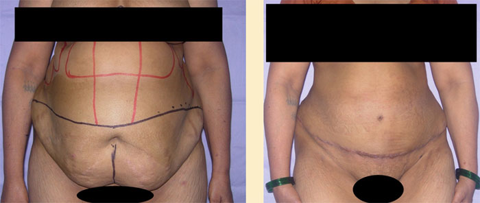 Tummy tuck before and after photos